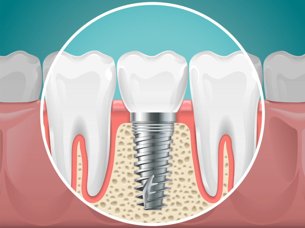 Stomatology illustrations. Dental implants and healthy teeth. Vector health tooth and implant stomatology, dentistry installation and fixture