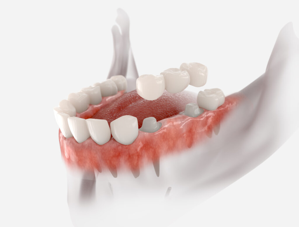 Three-unit dental bridge model showing fixed restoration with pontic between two crowns